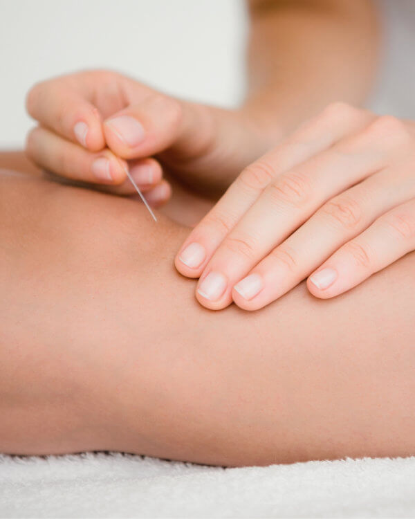 Akupunktur